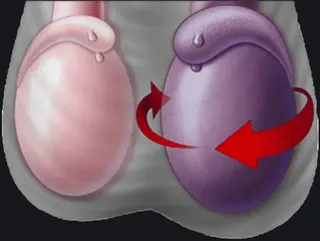 Testicular Torsion Crosshair
